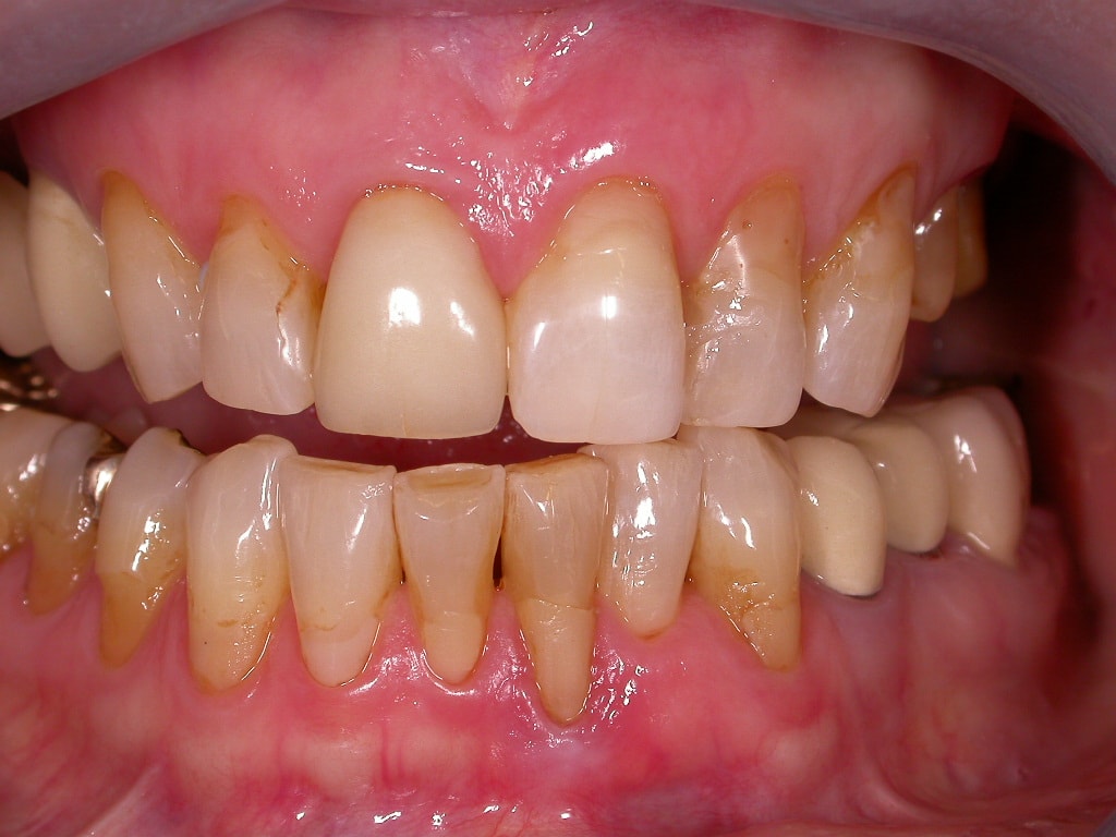 gelbliche Zähne mit vielen Kunststoffreparaturen